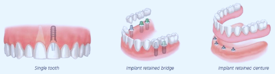 Full Mouth Dental Implants Costs